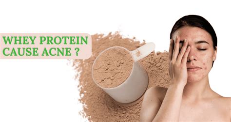 Does Whey Protein Cause Acne? Exploring the Connection Between Supplements and Skin Health